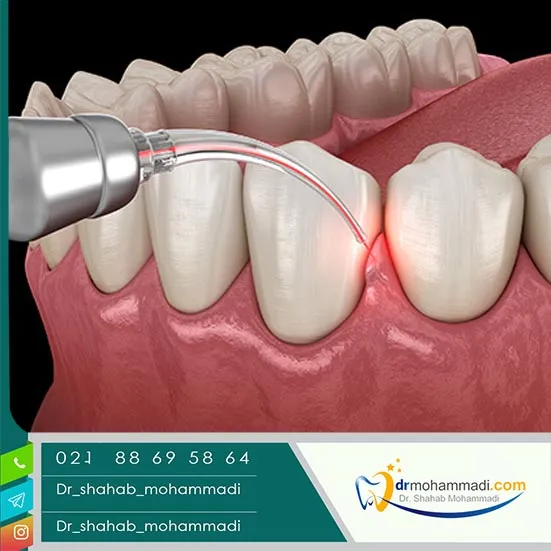 کاربرد لیزر در جراحی ایمپلنت